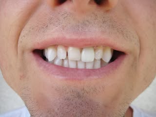 Patient smile before cosmetic treatment